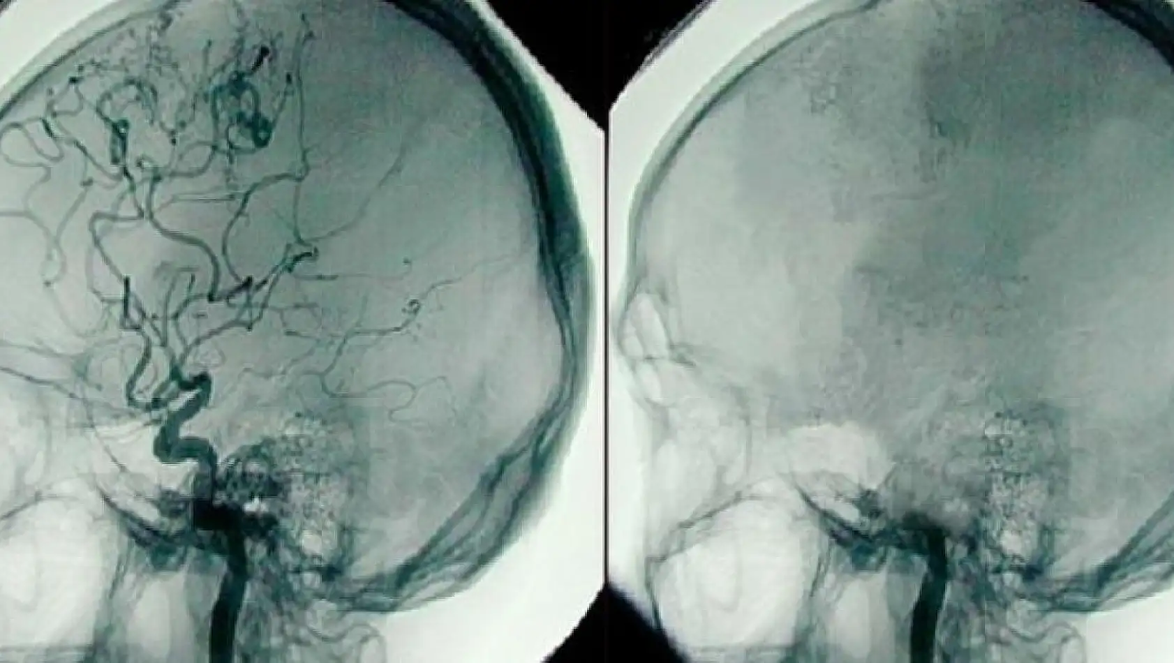 Beyin Ölümünde Yeni Kural! Onay Yoksa Organ Koruma Sona Erecek