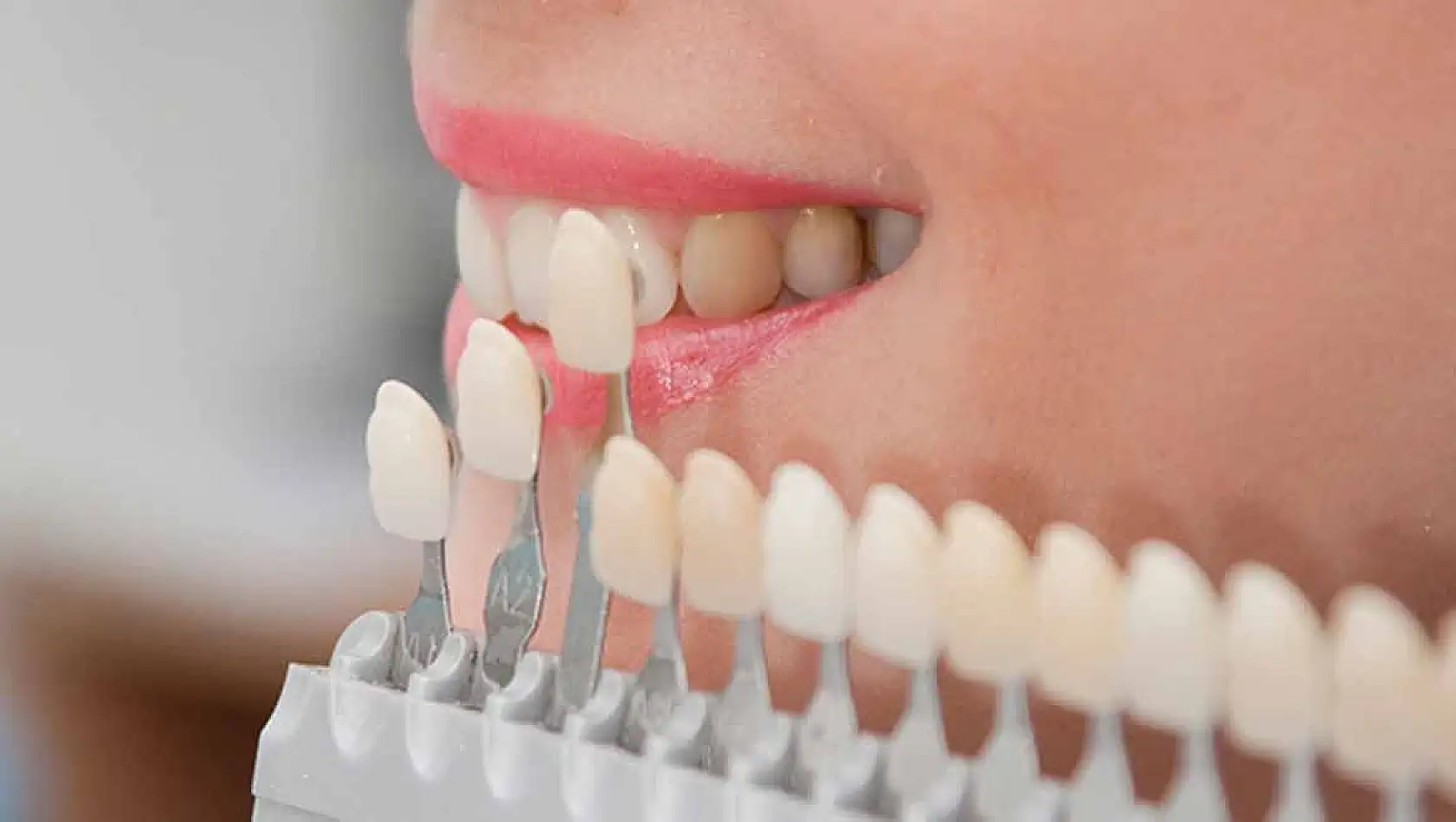 Gülüş tasarımı nedir ve neden 'kişiye özel' olmak zorundadır?