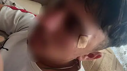 Öğretmen, çocuğa kafa attı! Suratı kan içinde kaldı