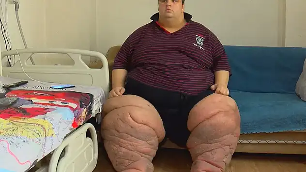 270 Kiloya Çıkaran Fil Hastalığı Şok Etti!