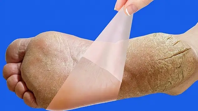 Ayakları sirkeli suda bekletmenin faydaları. Sirkeli suda ayaklarınızı bekletirseniz ne olur?