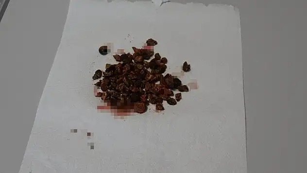 Böbreğinden 100'e yakın taş çıktı