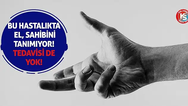 Bu Hastalıkta El, Sahibini Tanımıyor! Tedavisi de yok!