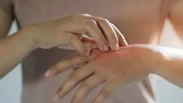 Çocuklarda güneş yanığı deri kanseri riskini 8 kat artırıyor
