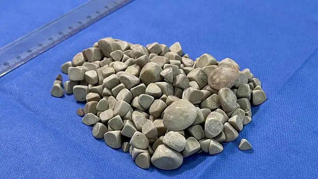 Doktorları bile şok etti! Vücudundan yüzlerce taş çıktı!