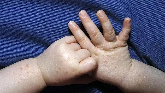 El, ayak ve ağız hastalığının yayılımı hijyenle önlenebiliyor