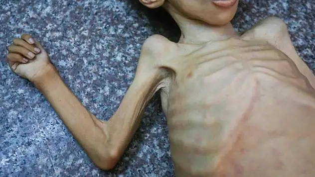 Gazze'de bir çocuk daha açlık nedeniyle hayatını kaybetti