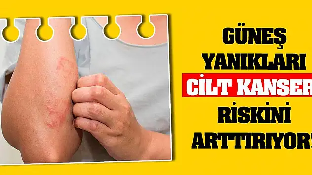 Güneş yanıkları cilt kanseri riskini arttırıyor!