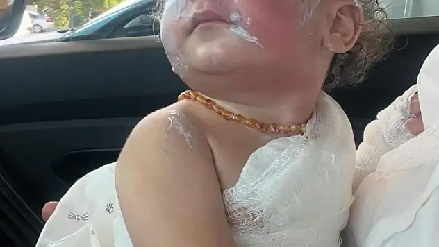 Kreşte çocuğun üzerine kahve döküldü