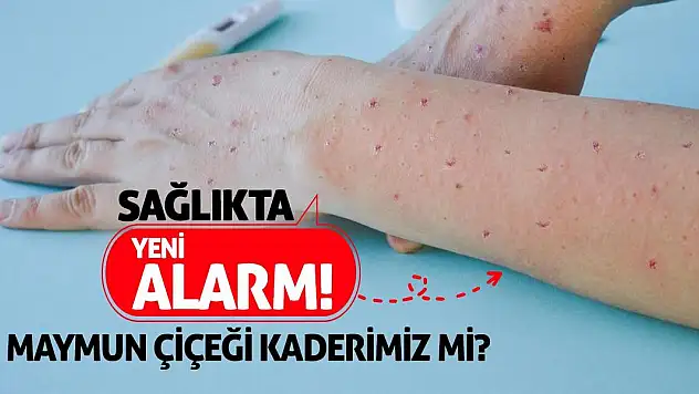 Sağlıkta Yeni Alarm! Maymun Çiçeği Kaderimiz Mi?