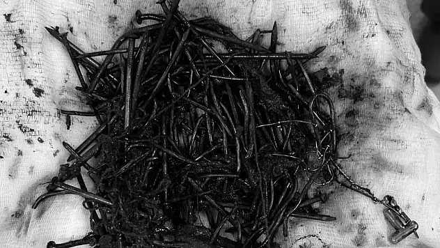 Zihinsel engelli kadın hastanın midesinden 1 kilo metal cisim çıktı