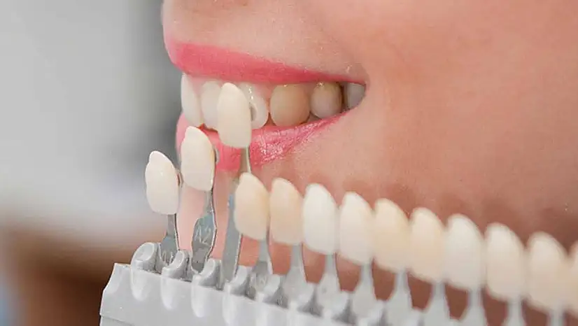 Gülüş tasarımı nedir ve neden 'kişiye özel' olmak zorundadır?