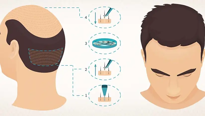 Türkiye'deki En İyi 5 Saç Ekimi Kliniği (2025)